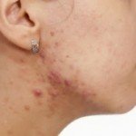 82b6e-pcos-acne