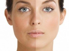 Melasma: i rimedi naturali per eliminarlo melasma