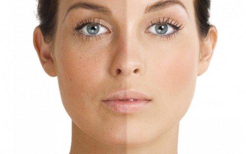 melasma