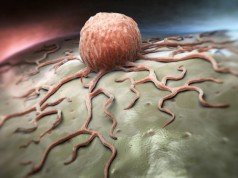 7 modi per ridurre il rischio di cancro all’intestino