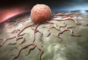 7 modi per ridurre il rischio di cancro all'intestino