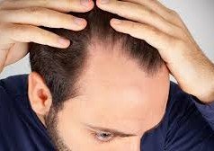 6 Rimedi alla caduta dei capelli nell’uomo