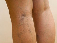 Vene varicose – 4 rimedi per combatterle in tempo vene varicose