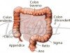 cancro intestinale