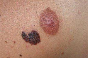 come-riconoscere-un-melanoma-cutaneo_5c45fcc28cbaa0081ae989327e34a624