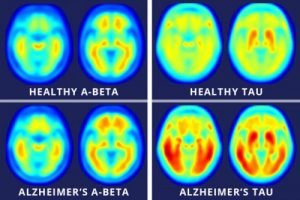 Aree attive nel cervello di un soggetto sano e quelle attive in un soggetto affetto da Alzheimer