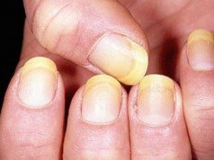 8 sintomi della salute delle unghie da non sottovalutare