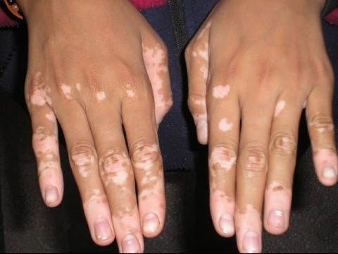 Vitiligine le 3 Cause principali
