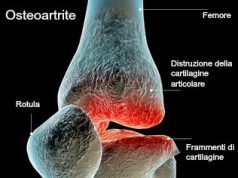 Osteoartrosi del ginocchio: Conosciamola meglio