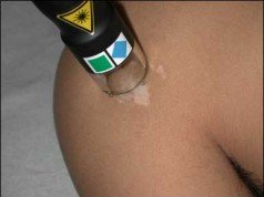 Vitiligine cura e cause